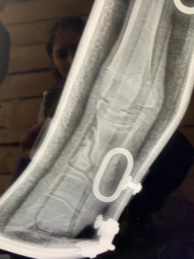 Redboot corrective foal split