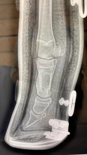 Redboot corrective foal split